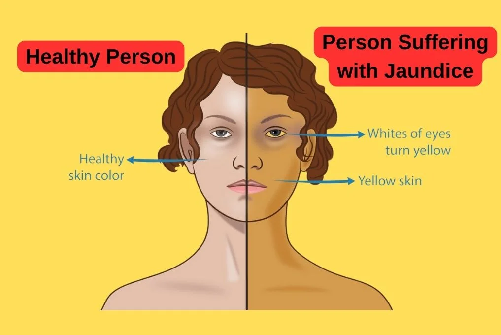 Best Jaundice Treatment in Indore