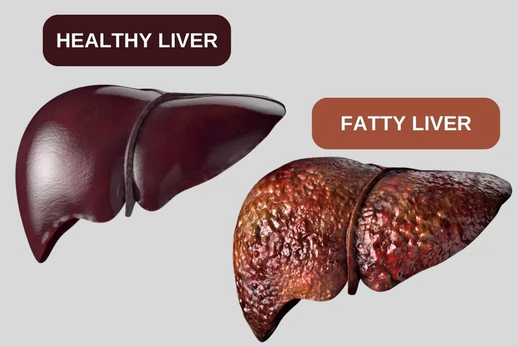 Best Fatty Liver Treatment in Indore