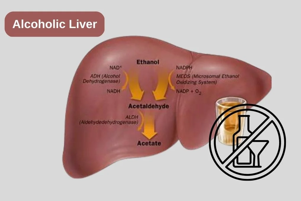 Best Alcoholic Liver Disease Treatment in Indore