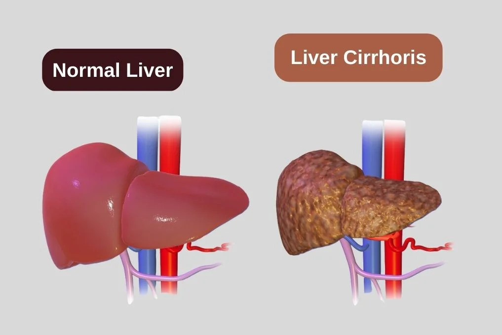 Best Liver Cirrhosis Treatment in Indore