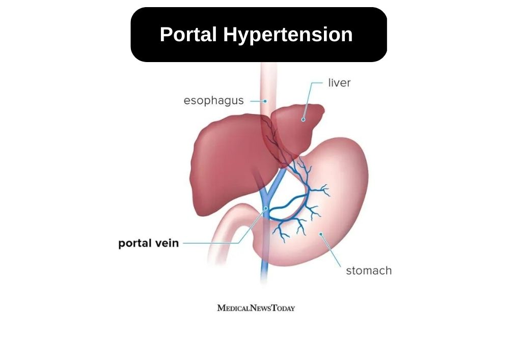Best Portal Hypertension Treatment in Indore