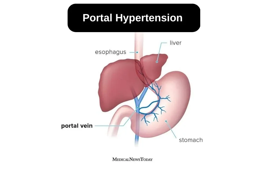 Best Portal Hypertension Treatment in Indore