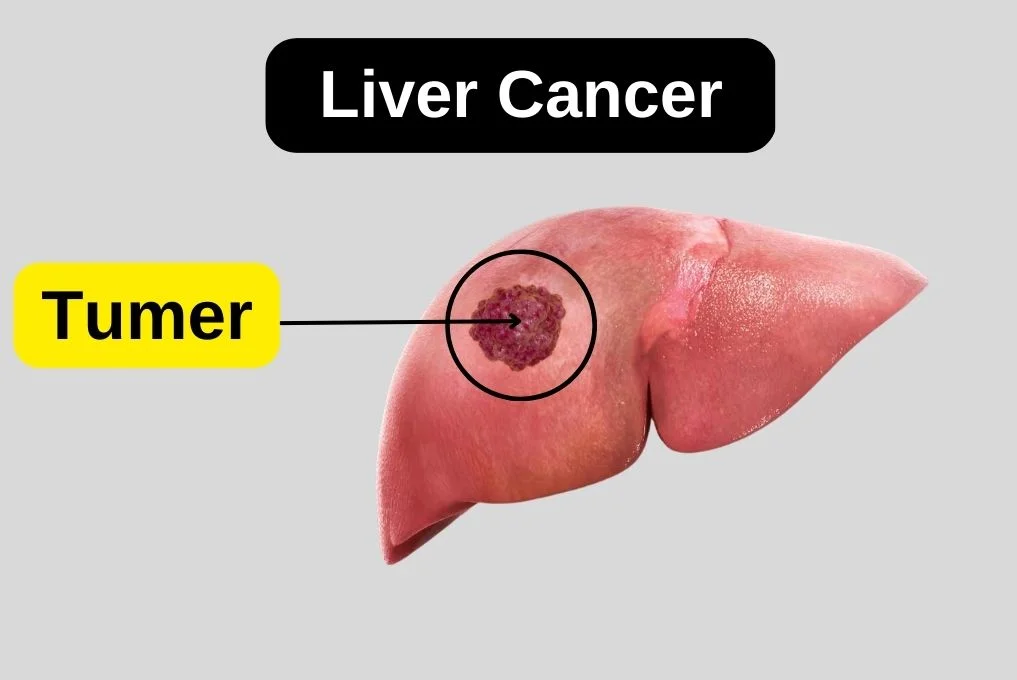 Best Liver Cancer Doctor in Indore