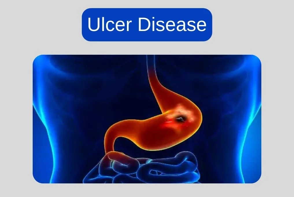 Ulcer Disease Treatment In Indore